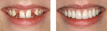 Porcelain veneers and dental crowns