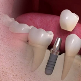 Dental Implants