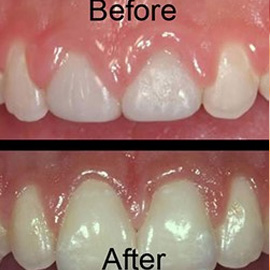 Gum Contouring